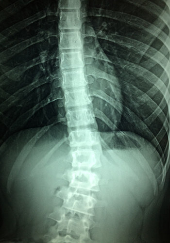 Spinal Cord Injury Victim